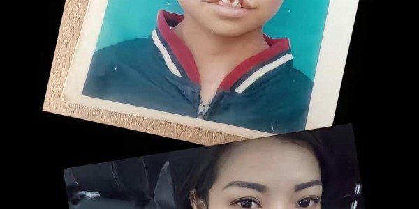 bob半岛体育-震惊！为声援李亚鹏，一漂亮女孩坦然展示自己唇腭裂手术前后照片